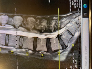 Recharging for Resilience: My Journey Through Back Surgery, 